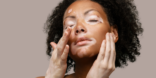 HOW ORGANIC SKINCARE CAN BENEFIT VITILIGO: A NATURAL APPROACH TO HEALTHY SKIN